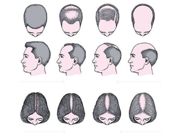 Androgena alopecija kod muškaraca i žena