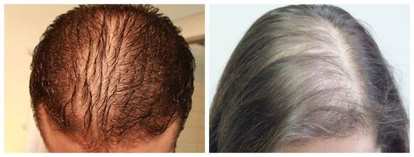 Difuzna alopecija