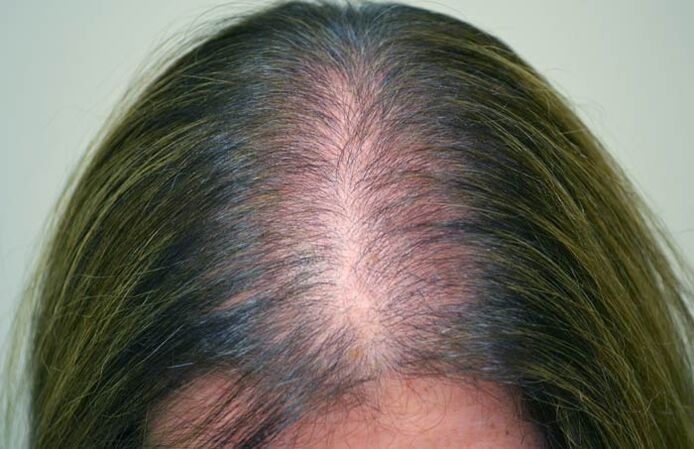 Alopecija (ćelavost) kod žena