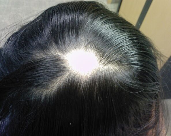 Alopecija areata ili alopecija areata kod žena