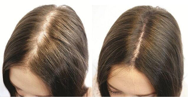 Rezultat pravodobnog liječenja alopecije kod žena