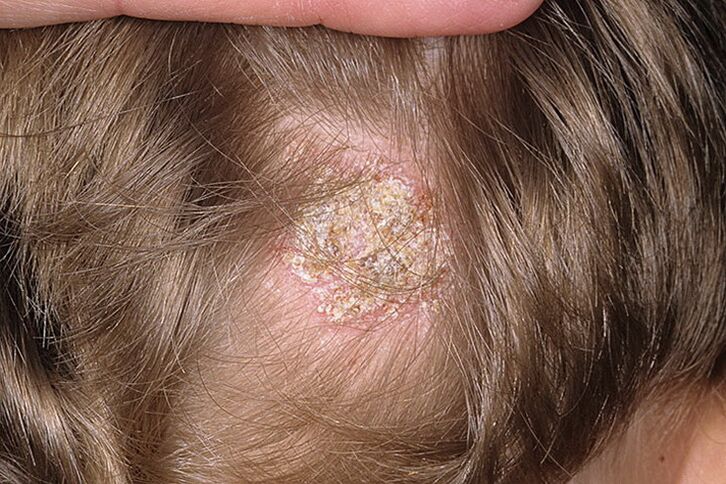 Seboreični tip alopecije kod žena