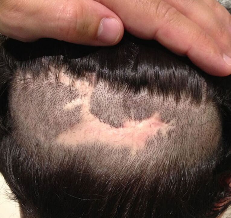 cicatricijalna alopecija vlasišta