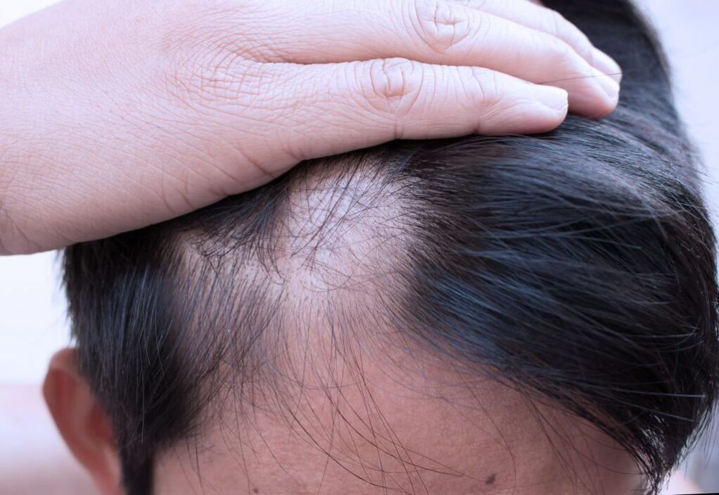 difuzna alopecija glave