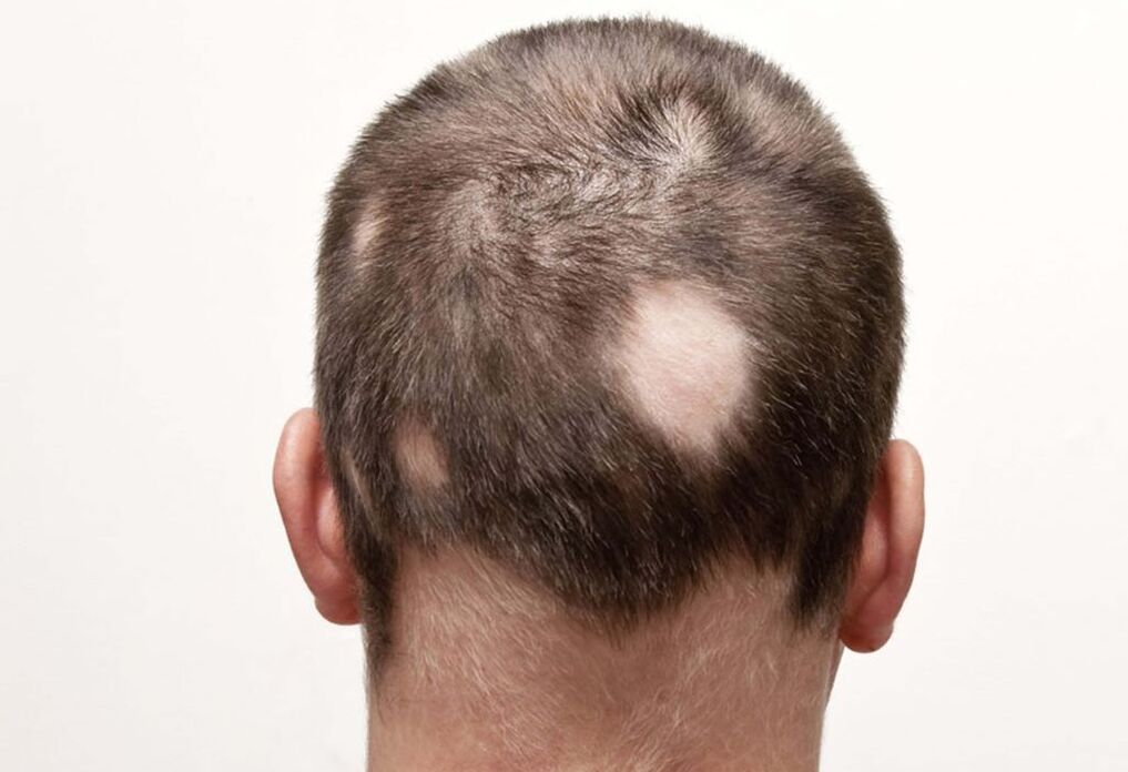 gnijezdeća (žarišna) alopecija glave