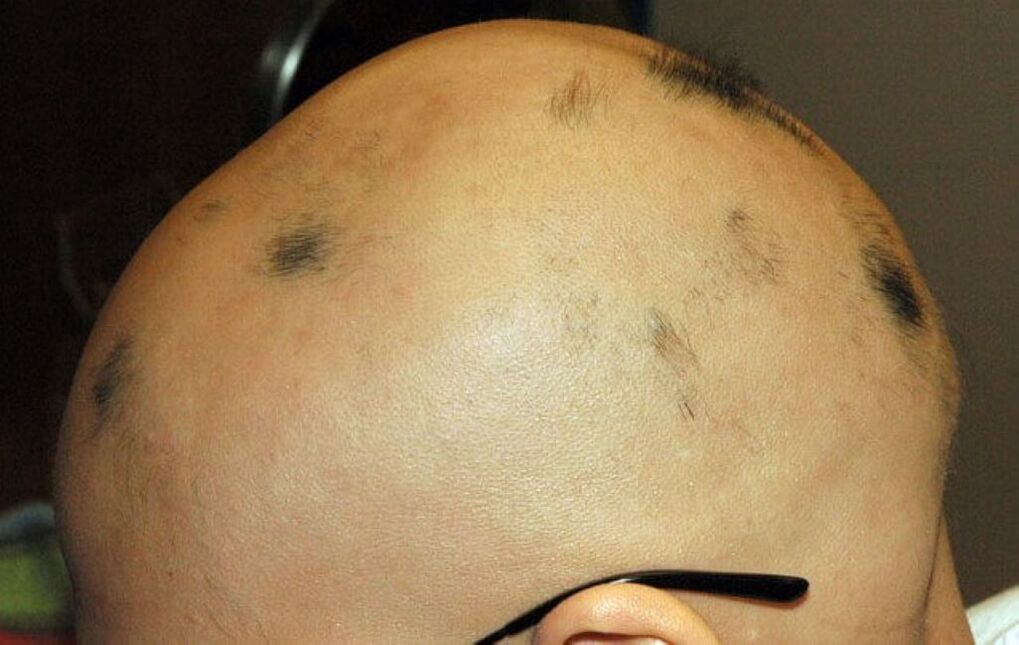 potpuna alopecija vlasišta kod muškaraca
