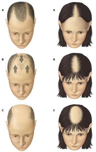 Androgena alopecija kod muškaraca i žena