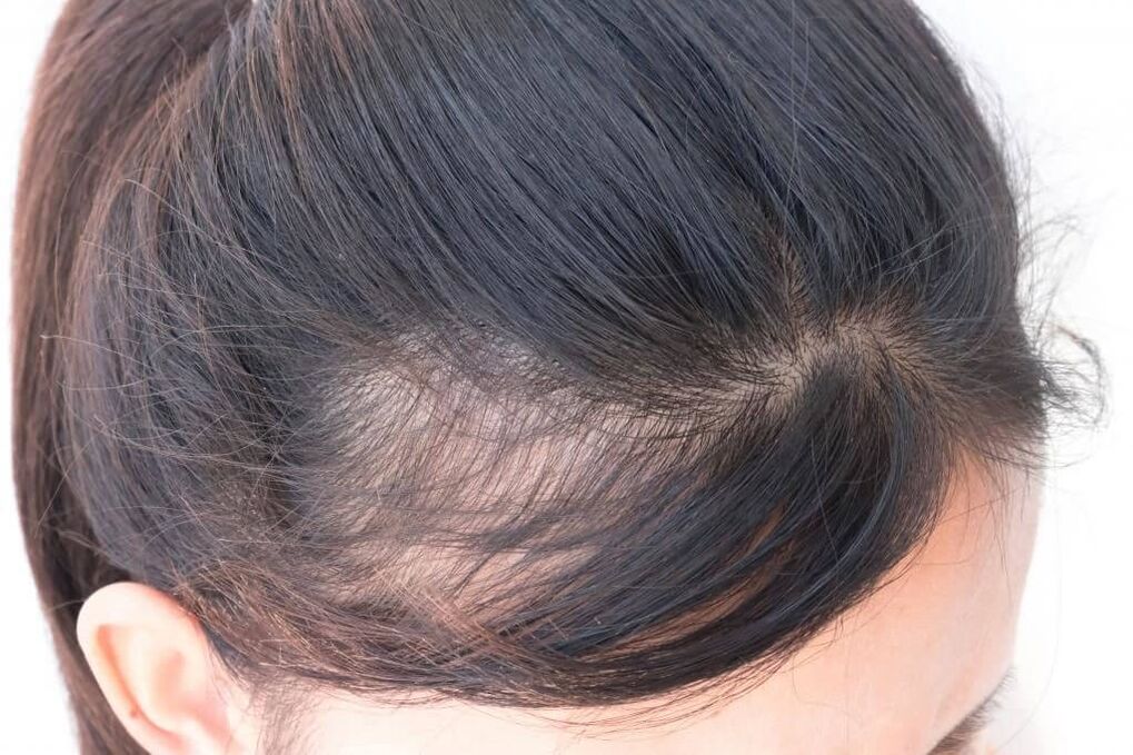 Androgena alopecija kod žena