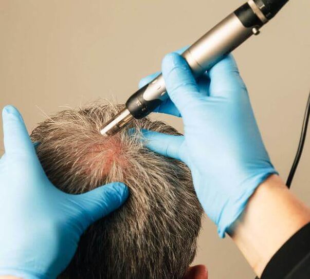 Fizioterapija za liječenje androgene alopecije