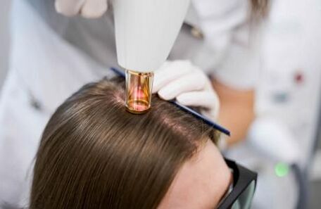 Laserska terapija androgene alopecije