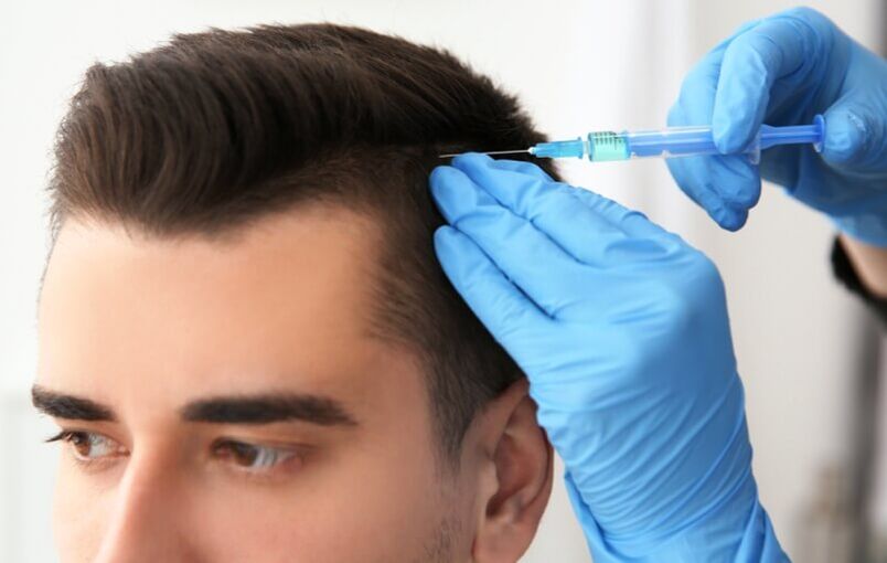 Mezoterapija za poticanje rasta kose kod androgene alopecije